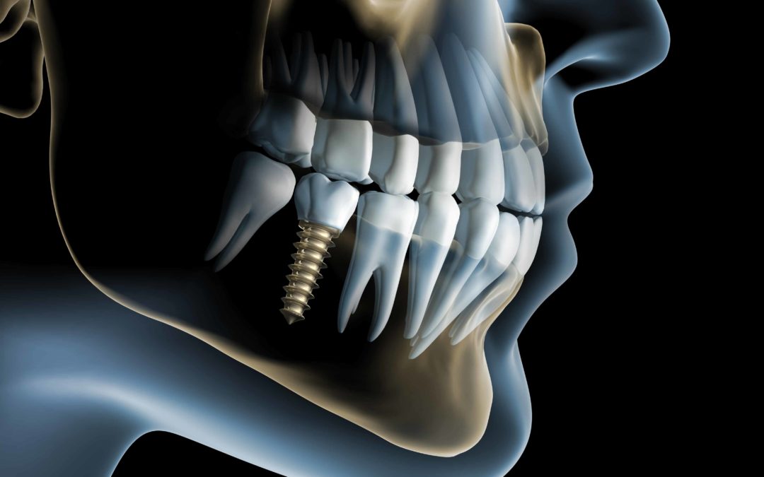Socket preservation during Covid-19 restrictions
